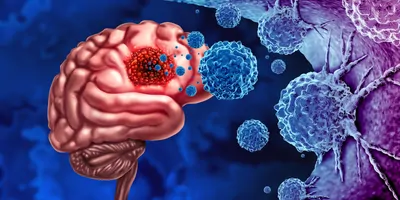 3D illustration of cancer cells attacking a human brain as in gliomas.