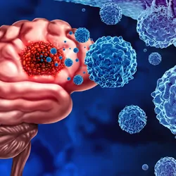 3D illustration of cancer cells attacking a human brain as in gliomas.