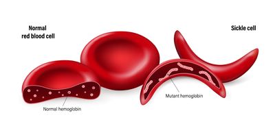 Graphical representation of normal red blood cells and sickled red blood cells with normal and mutant hemoglobin chains in them.