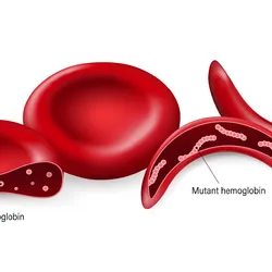 Graphical representation of normal red blood cells and sickled red blood cells with normal and mutant hemoglobin chains in them.