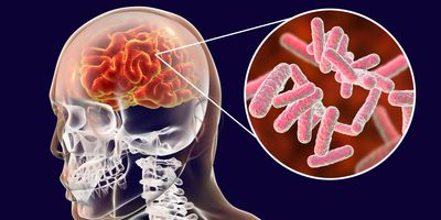 3D illustration of bacterial meningitis showing rod-shaped bacilli near a human brain representation.