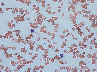 Researchers Develop New Method to Rapidly, Reliably Monitor Sickle Cell Disease
