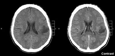 A Targeted Approach to Treating Glioma