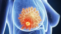 breast tumor