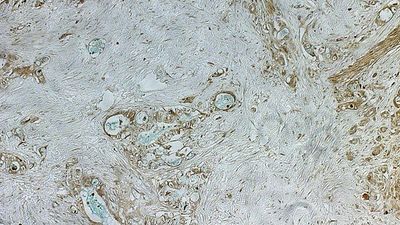 Inherited Pancreatic Cancer Risk Mutation Identified