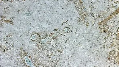 Inherited Pancreatic Cancer Risk Mutation Identified