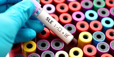 Systemic lupus erythematosus
