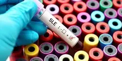Systemic lupus erythematosus