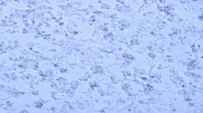 New CAR T Cells Could Help Avoid Patient Relapse in Blood Cancers