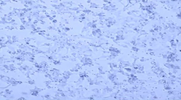New CAR T Cells Could Help Avoid Patient Relapse in Blood Cancers