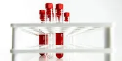 Blood samples in a rack