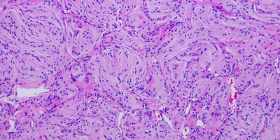 Meningioma