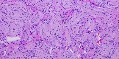 Meningioma