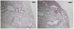 A Mutation In SFTPA1 Causes Idiopathic Pulmonary Fibrosis