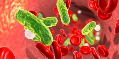 Sepsis