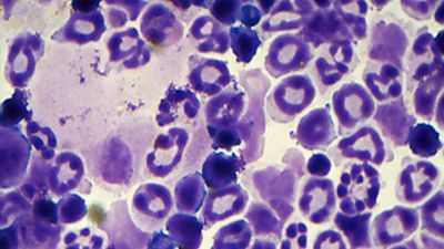 Scientists Close in on Mystery Surrounding Dangerous Blood Syndromes