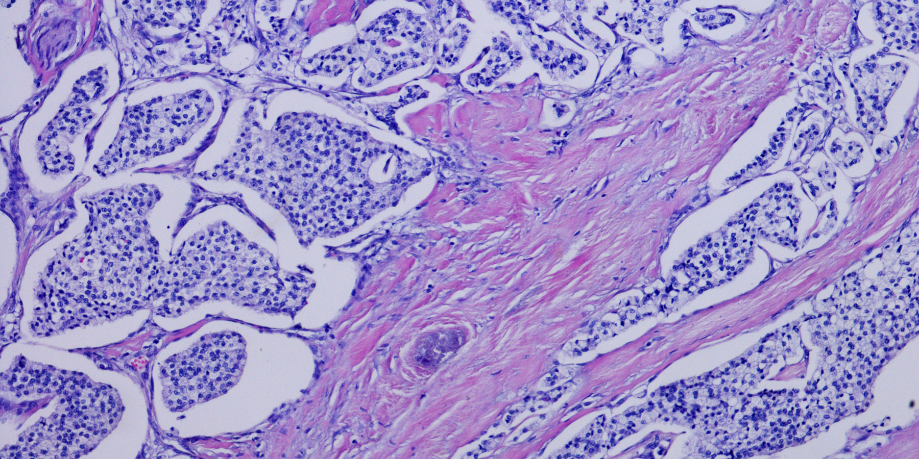 pancreatic cancer