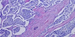 pancreatic cancer