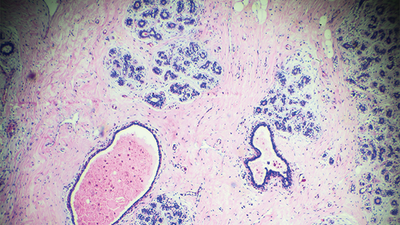 Drug Improves Survival in Metastatic Breast Cancer