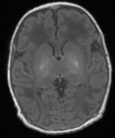 A 15-Minute Scan Could Help Diagnose Brain Damage in Newborns