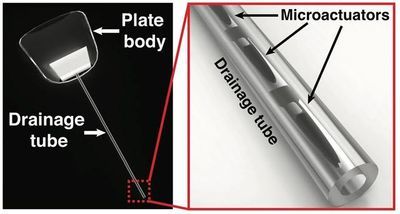 Purdue&#39;s Giant Leap Toward Personalized Medicine Helps Eyes Drain Themselves