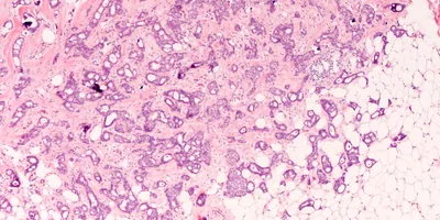 Microscopy photo of breast cancer sample with histologic staining.