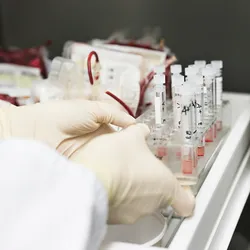 Preparing blood samples related to sickle cell disease treatment