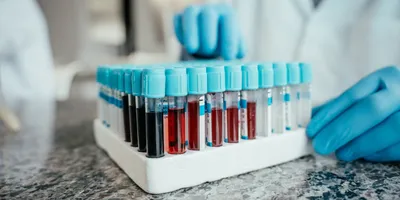 Blood samples in test tubes for endometriosis biomarker research