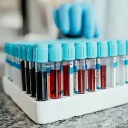 Blood samples in test tubes for endometriosis biomarker research