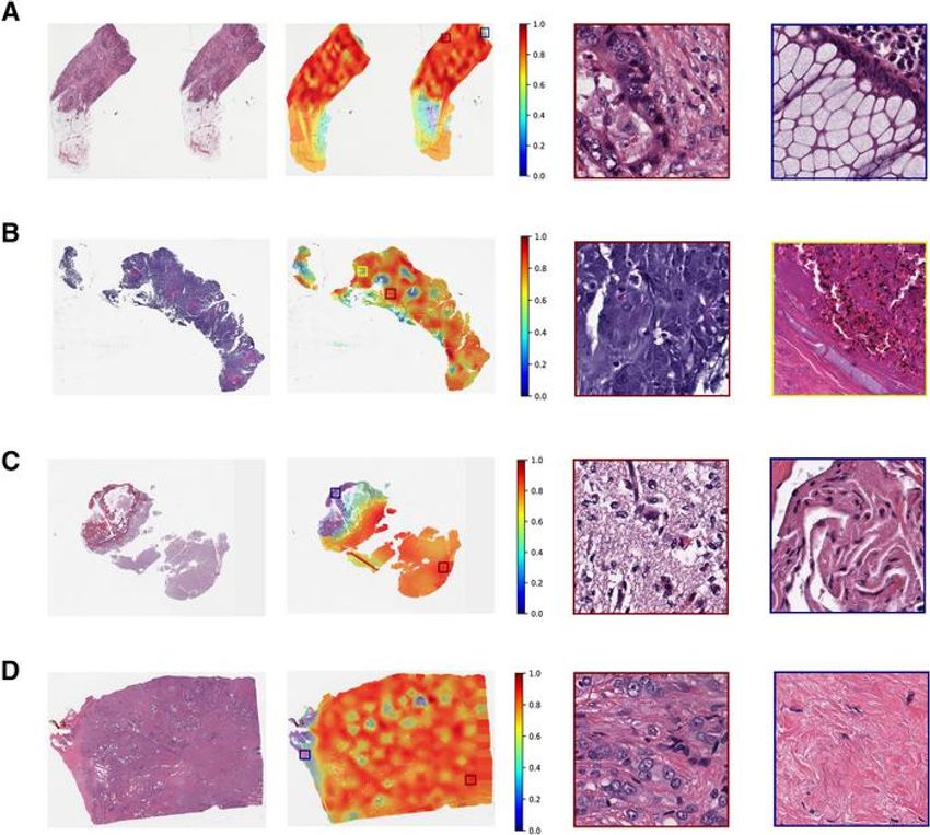 Whole-slide images showing multiple diagnostic outputs from AI Whole-slide images showing multiple diagnostic outputs from AI