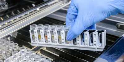 Laboratory analysis for chronic kidney disease detection