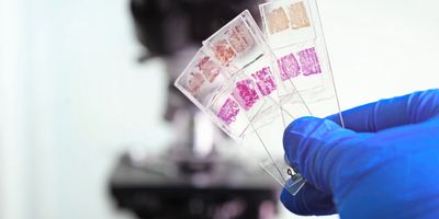 A gloved hand holds three slides with biopsy samples against a microscope in the background. 