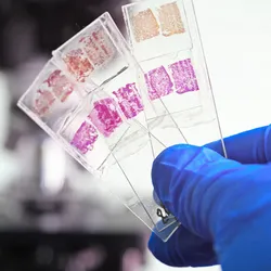 A gloved hand holds three slides with biopsy samples against a microscope in the background. 