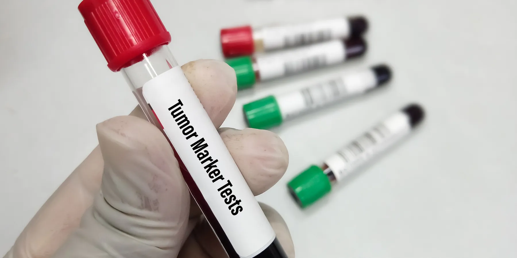 A gloved hand holds a blood vacutainer with tumor markers tests printed against four blood vacutainers set in the background.
