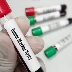 A gloved hand holds a blood vacutainer with tumor markers tests printed against four blood vacutainers set in the background.