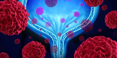 Graphic illustration of a human urinary bladder in the background and cancer cells floating in and around the bladder.