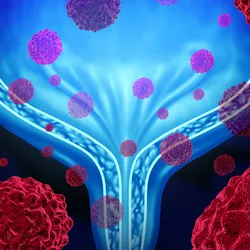 Graphic illustration of a human urinary bladder in the background and cancer cells floating in and around the bladder.