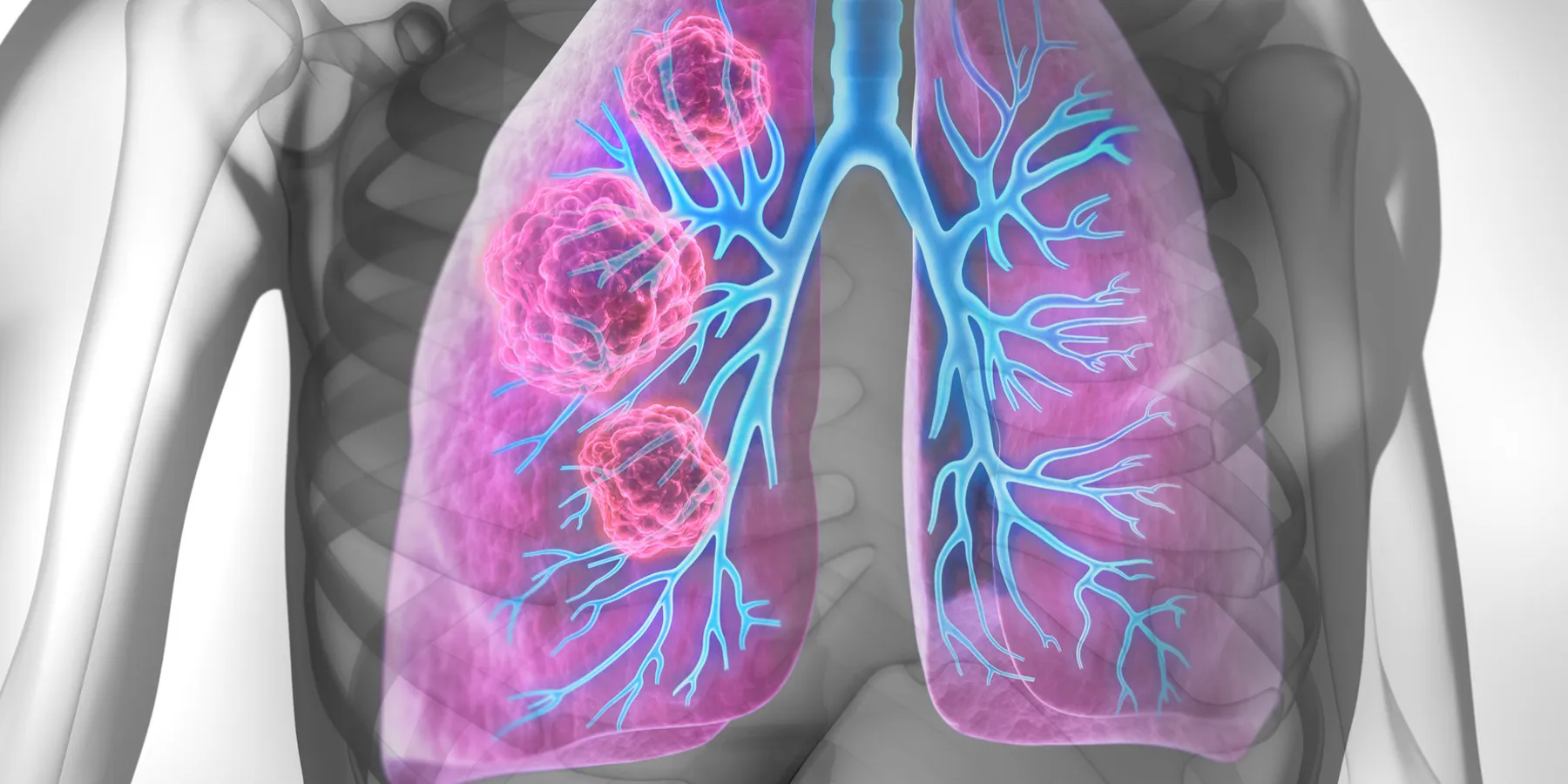 A 3D illustration of human lungs with tumors in the right lung.