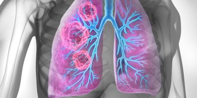 A 3D illustration of human lungs with tumors in the right lung.