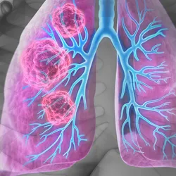 A 3D illustration of human lungs with tumors in the right lung.
