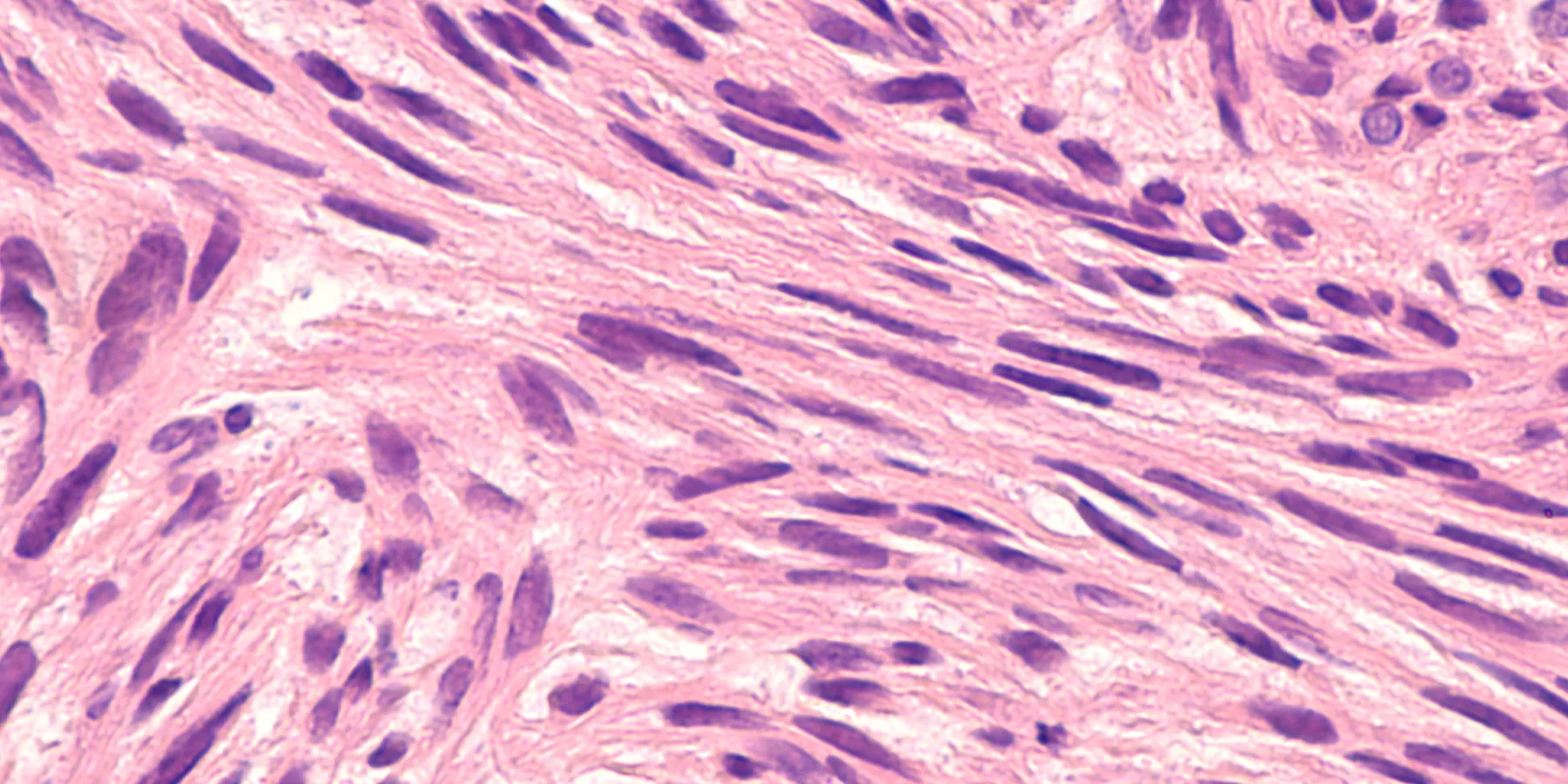 Microscopic image of a leiomyosarcoma, a type of soft tissue sarcoma of smooth muscle.