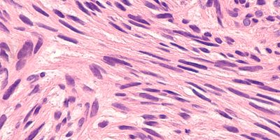 Microscopic image of a leiomyosarcoma, a type of soft tissue sarcoma of smooth muscle.