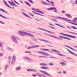Microscopic image of a leiomyosarcoma, a type of soft tissue sarcoma of smooth muscle.