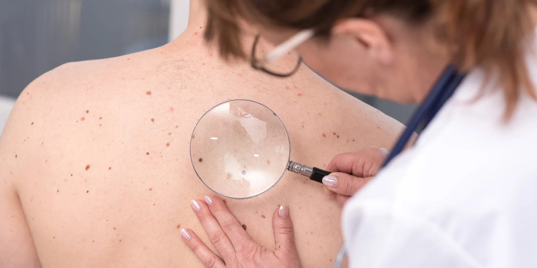 A female dermatologist examines moles and skin on the back of a male patient using a magnifying lens.