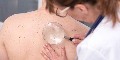 A female dermatologist examines moles and skin on the back of a male patient using a magnifying lens.