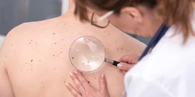 A female dermatologist examines moles and skin on the back of a male patient using a magnifying lens.