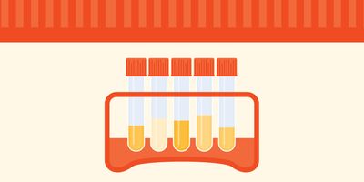 Illustration of a urine sample test tube rack in a clinical laboratory.
