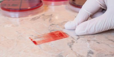 Photo of a medical laboratory scientist wearing gloves preparing a blood smear test on a glass slide.