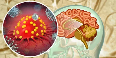 3D illustration of brain tumor being attacked by immune cells against a background of a human brain in a head X-ray image.