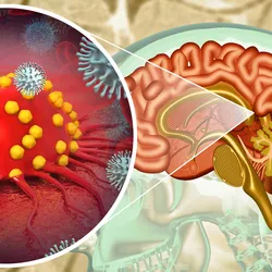 3D illustration of brain tumor being attacked by immune cells against a background of a human brain in a head X-ray image.